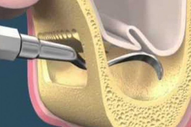 Elevació del si maxil·lar en els implants dentals